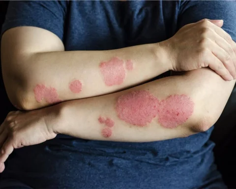 Mediterranean Diet Shown to Improve Psoriasis Symptoms by Up to 75%