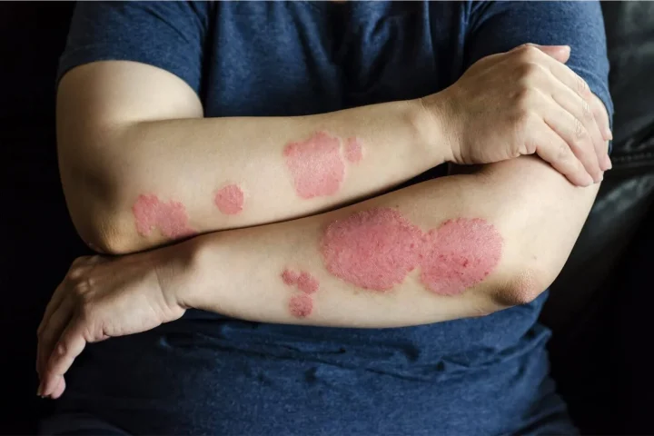 Mediterranean Diet Shown to Improve Psoriasis Symptoms by Up to 75%