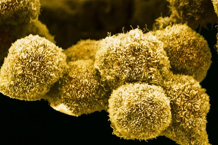 Experimental Drug Offers New Hope for Pancreatic Cancer Patients