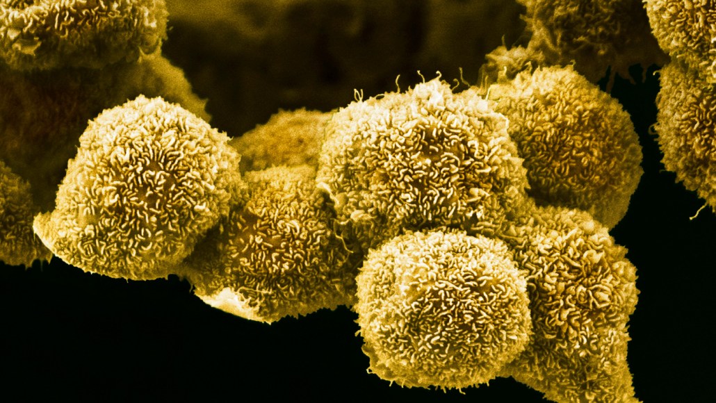 Experimental Drug Offers New Hope for Pancreatic Cancer Patients