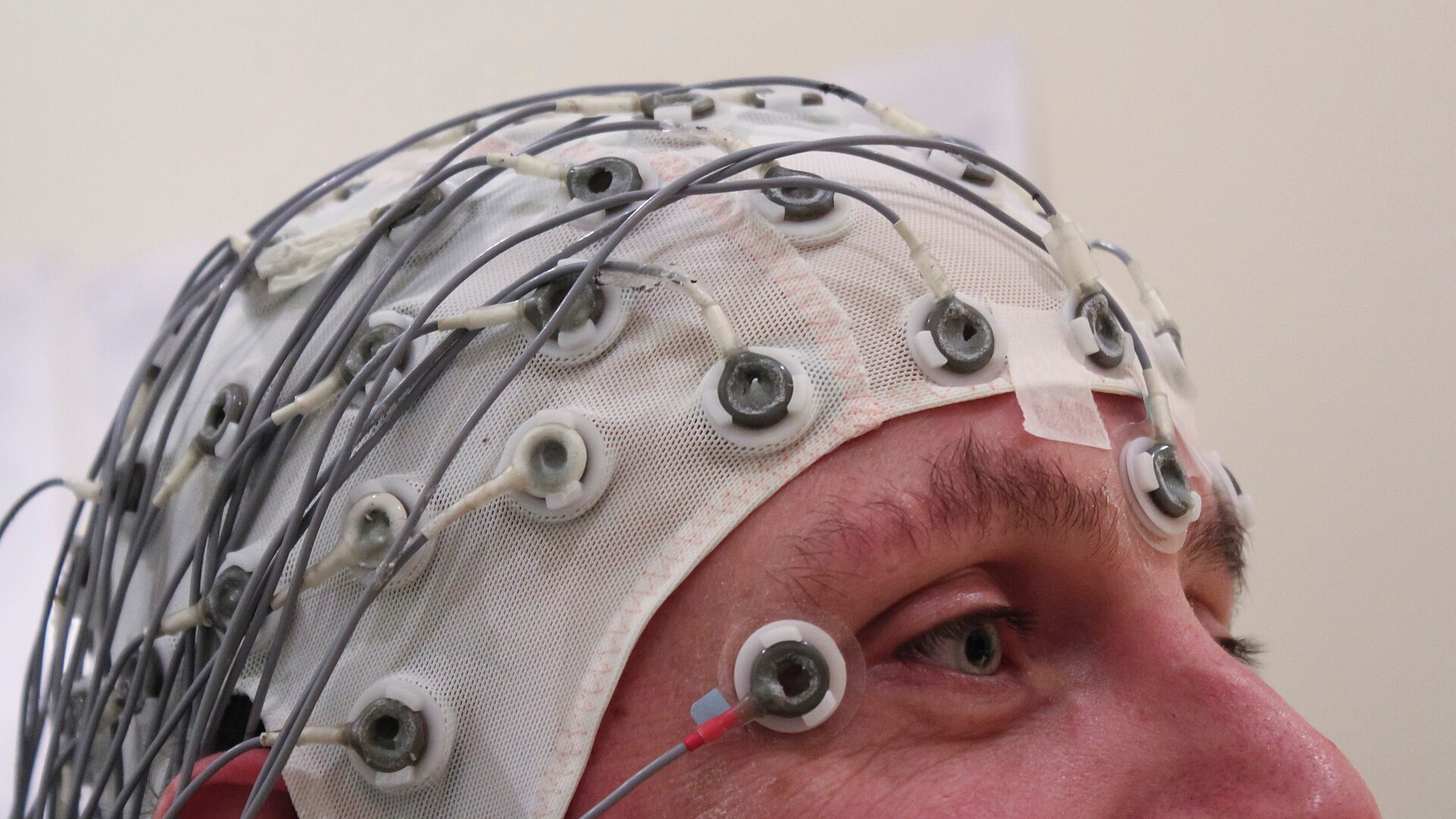 A brain map first, then magnetic pulses: the cleared PTSD treatment reporting 68% remission
