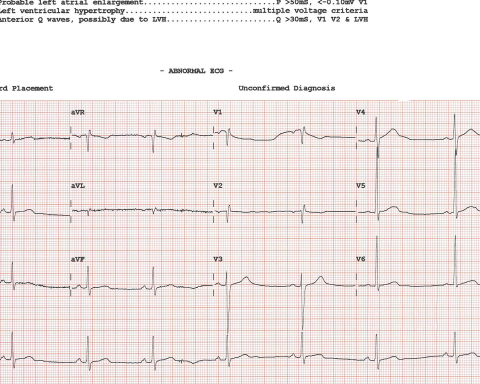 AI spots an overlooked ECG pattern tied to sudden cardiac death risk