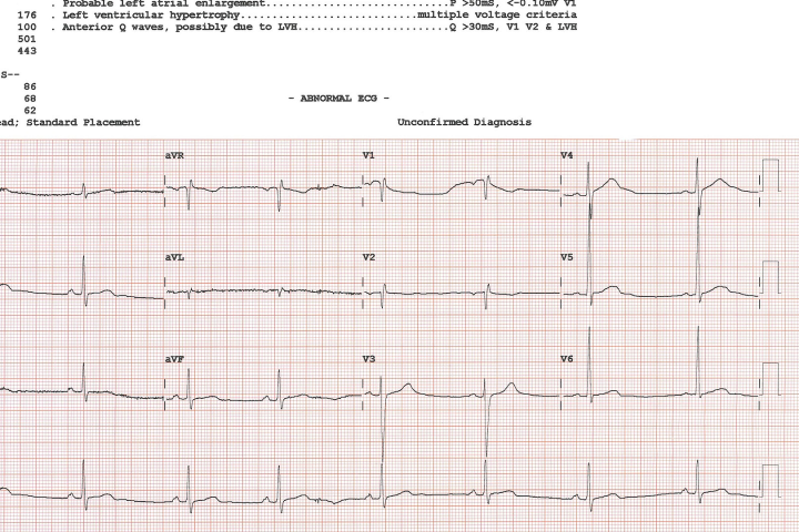 AI spots an overlooked ECG pattern tied to sudden cardiac death risk