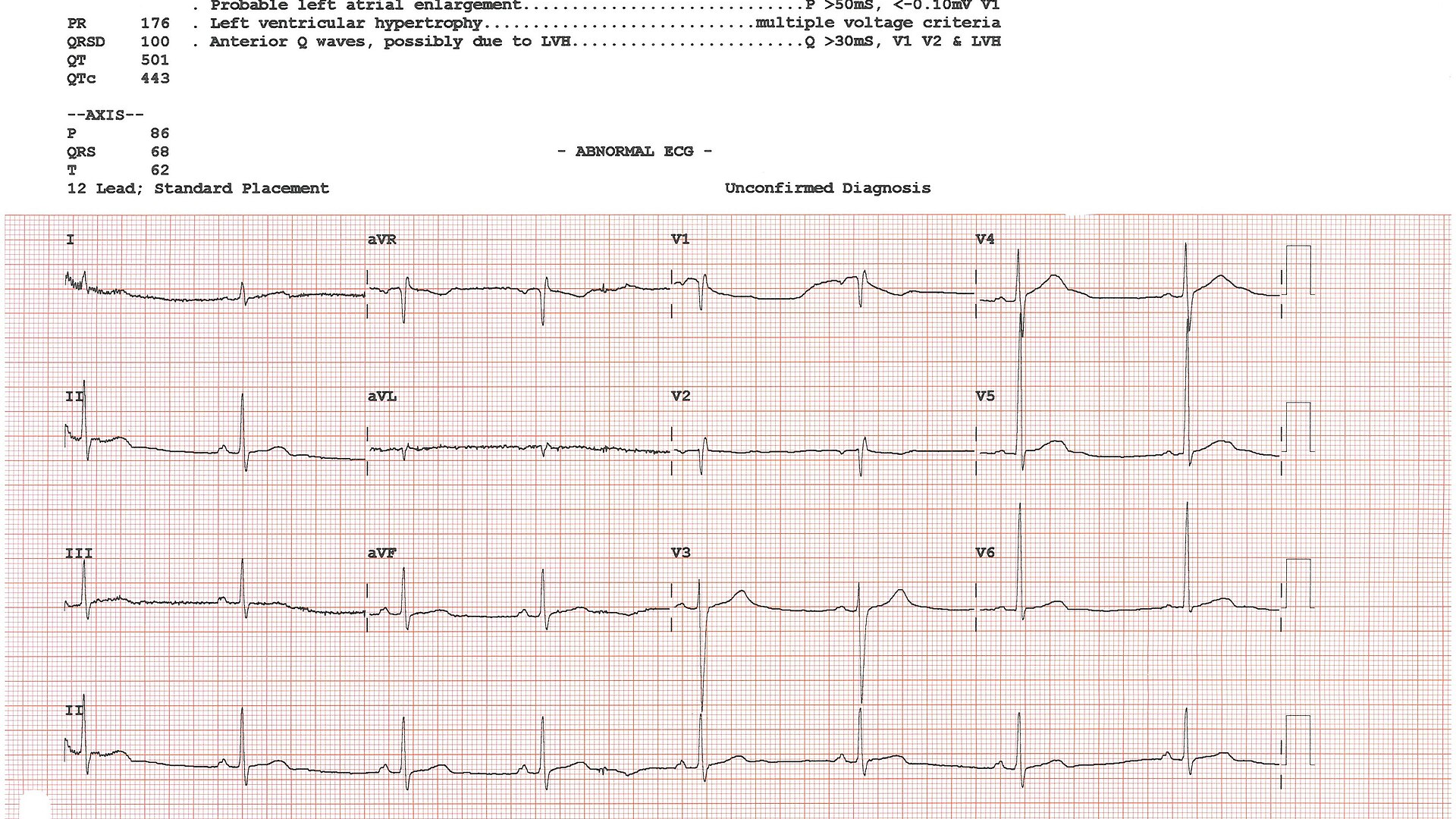 AI spots an overlooked ECG pattern tied to sudden cardiac death risk